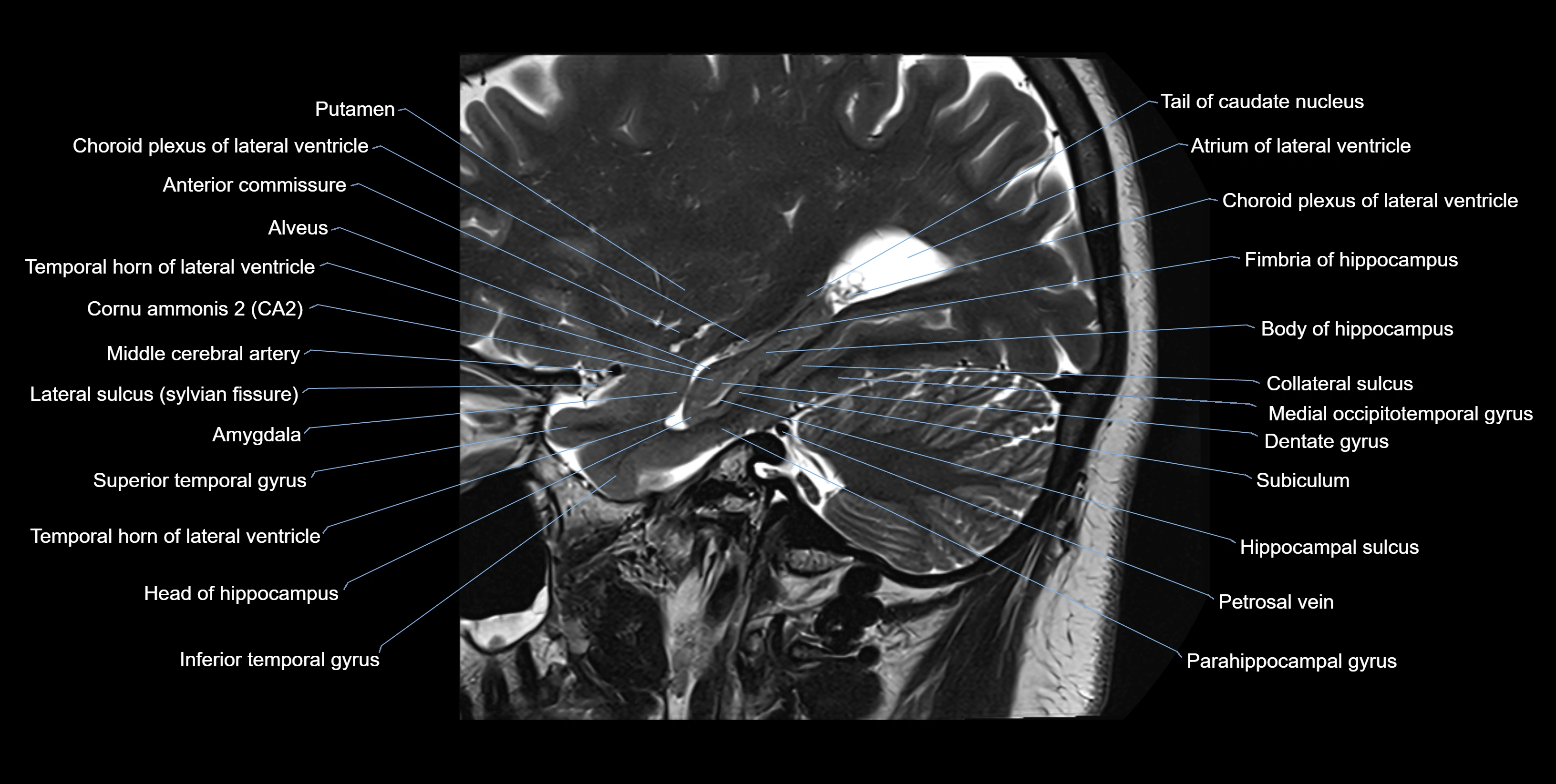 hippocampus sagittal cross sectional anatomy 3T MRI images -img-10005.webp